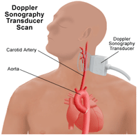 Illustration of a Doppler sonography transducer