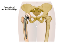 Illustration of an example of an artificial hip