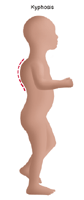 Illustration of a child with kyphosis