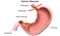 Illustration demonstrating pyloric stenosis