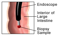 Illustration demonstrating a colonoscopy, part 2