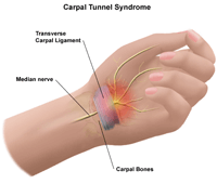 Illustration of hand anatomy of carpal tunnel syndrome