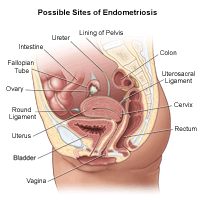 Illustration demonstrating possible sites of endometriosis