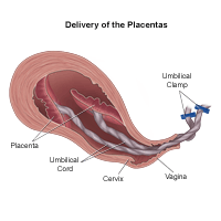 Illustration of the delivery of the placenta