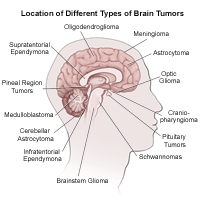 Illustration of the brain detailing common tumor sites, adult