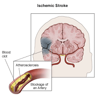 Illustration of Ischemic Stroke