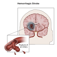 Illustration of hemorrhagic stroke