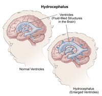 Illustration of hydrocephalus