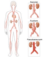 Illustration of the different types of abdominal aortic aneurysm
