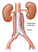 Illustration of aortic graft