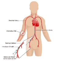 Illustration demonstrating catheter sites