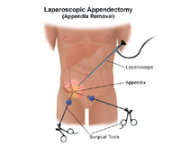 Illustration of laparoscopy