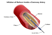 Illustration of inflated angioplasty balloon inside obstructed coronary artery