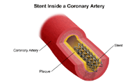 Illustration of stent inside coronary artery