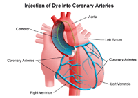 Illustration of coronary arteries after injection of dye used in cardiac catheterization or PTCA