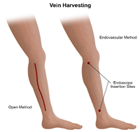 Illustration of endovascular vein harvesting