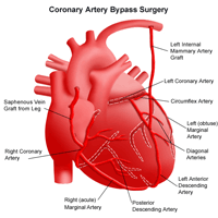 Illustration of the anatomy of the heart following coronary artery bypass surgery 