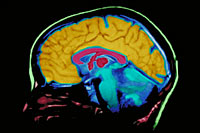 A picture of a MRI brain scan film