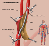 Illustration of carotid endarterectomy