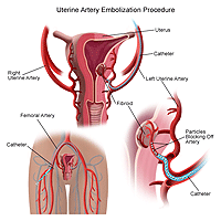 Illustration of a uterine artery embolization procedure