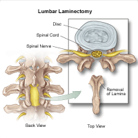 Illustration of a lumbar laminectomy