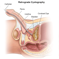 Illustration of retrograde cystography