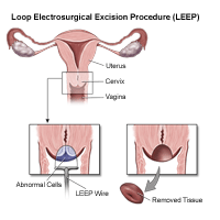 Illustration of a LEEP procedure