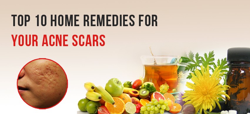 Home Remedies For Acne Scars