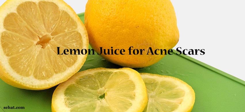 Lemon Juice for Acne Scars