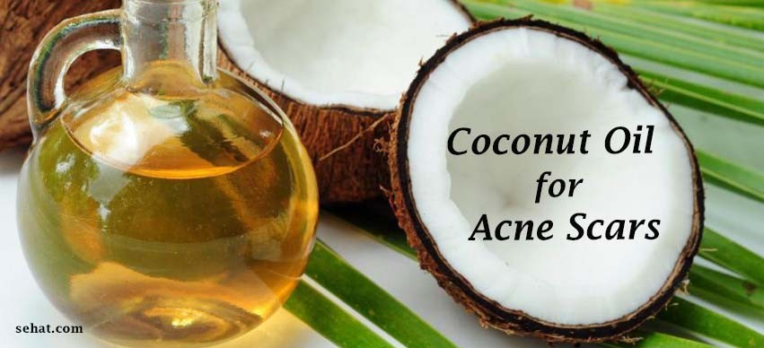 Coconut Oil for Acne Scars