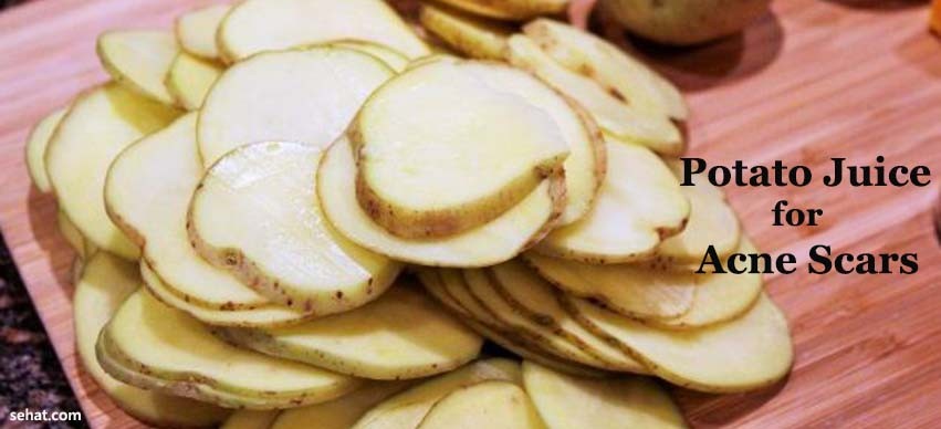 Potato Juice for Acne Scars