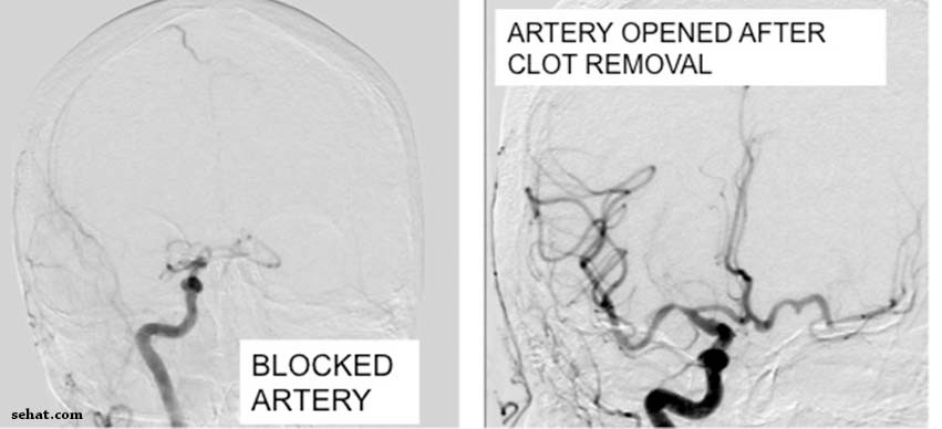 Before and After clot removal