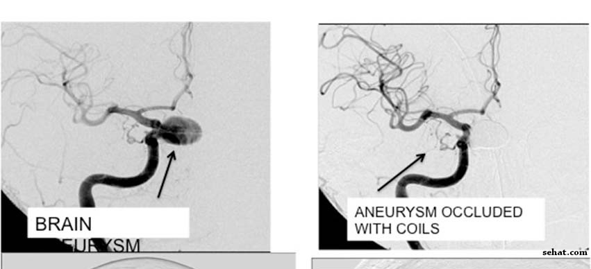 Aneurysm Occluded with coils