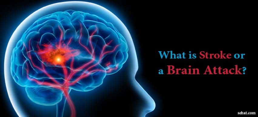 What is Stroke or a Brain Attack?