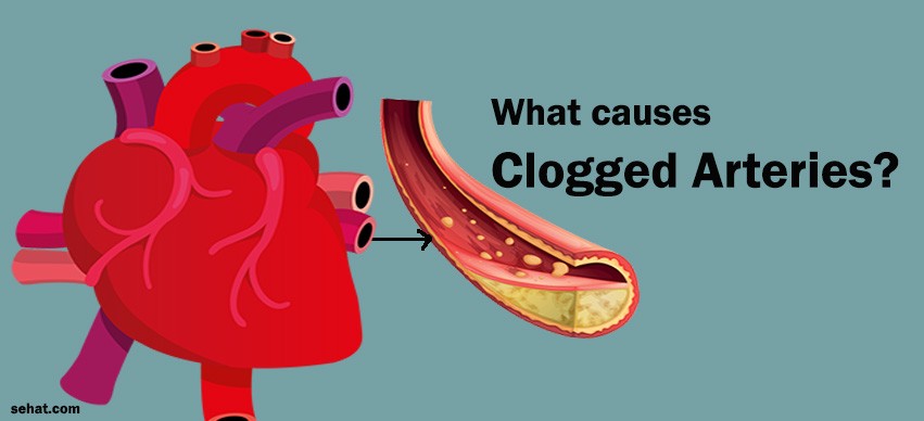 What causes Clogged Arteries?