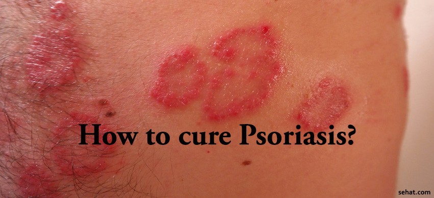 How to cure psoriasis?