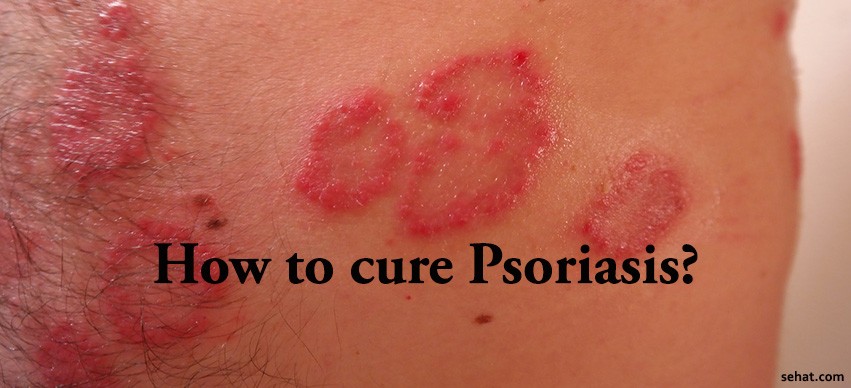 Tips to Cure Psoriasis | Sehat