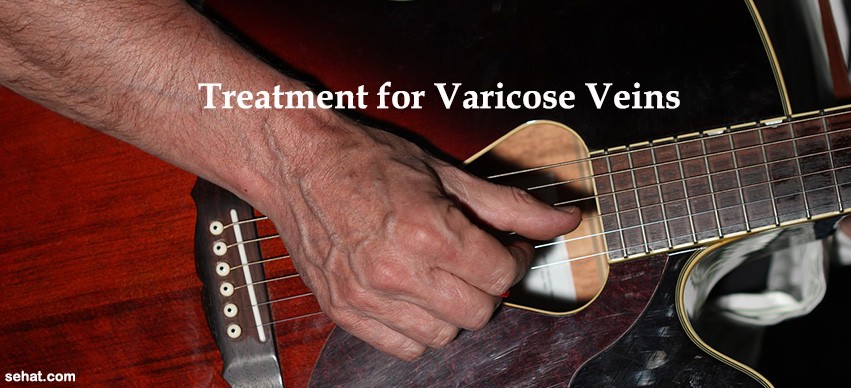 Treatment for Varicose Veins