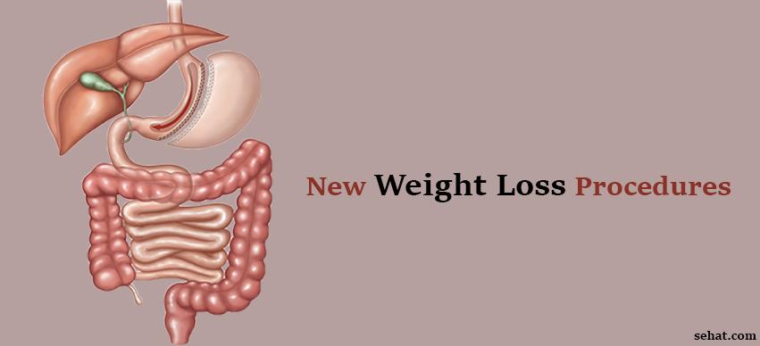 New weight loss procedures