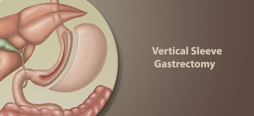 vertical sleeve gastrectomy