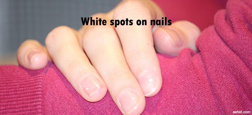 white spots on nails;