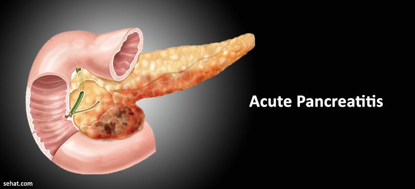 Acute Pancreatitis