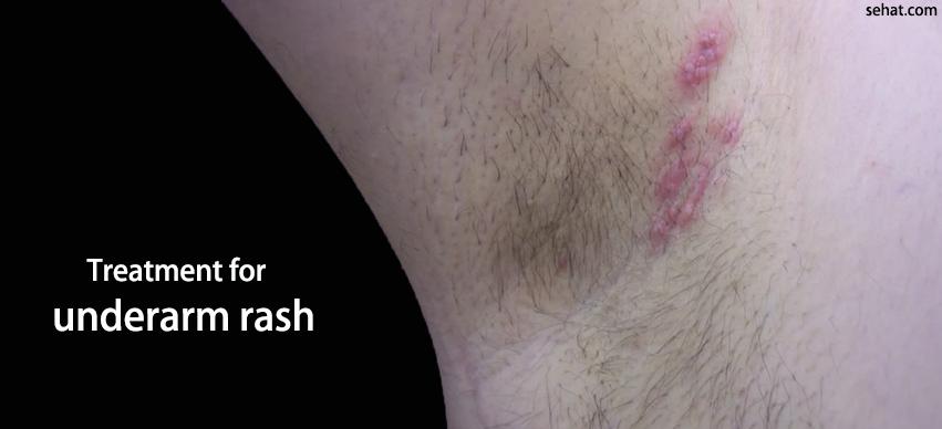 Treatment for underarm rash