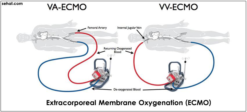 Extracorporeal Membrane Oxygenation