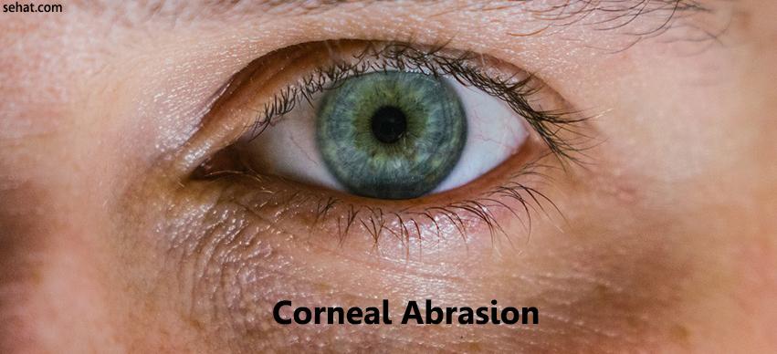 Corneal abrasion