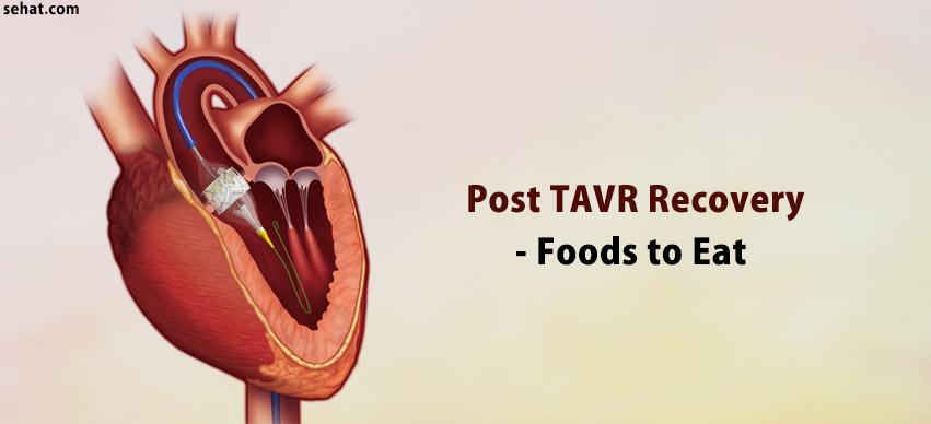 Post TAVR Recovery - Foods to Eat