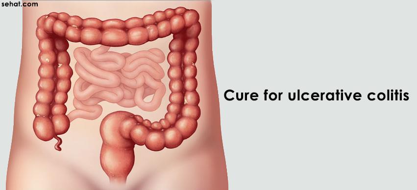 Cure for ulcerative colitis