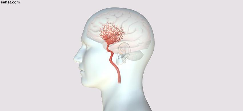 Moyamoya syndrome