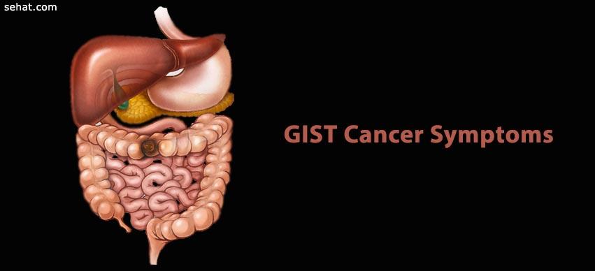 gist cancer symptoms -sehat