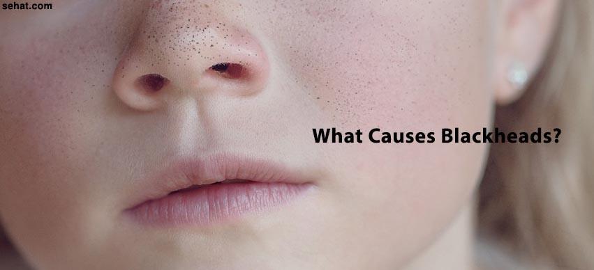 What causes blackheads and how to prevent blackheads? | Sehat